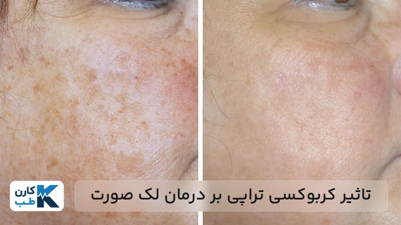 تاثیر کربوکسی تراپی بر درمان لک صورت