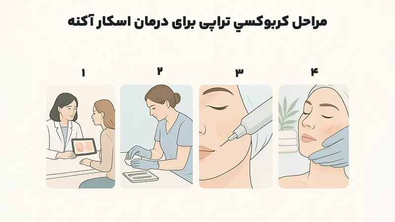 مراحل کربوکسي تراپی برای درمان اسکار آکنه
