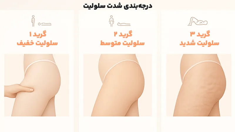 درجه‌بندی سلولیت