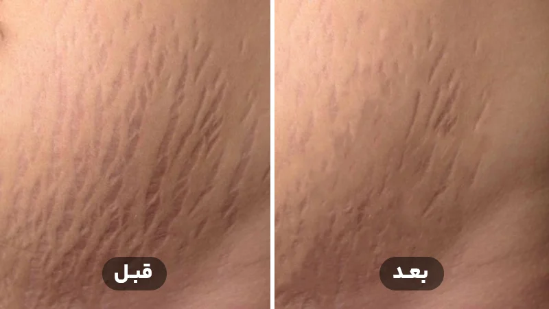 کربوکسی تراپی استرچ مارک شکم