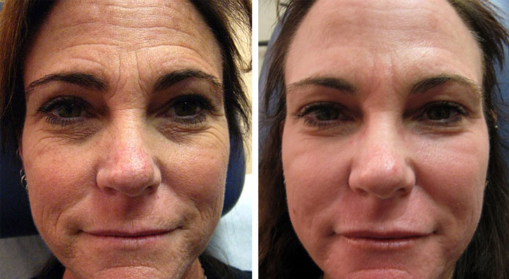 عکس قبل و بعد کربوکسی تراپی برای جوانسازی صورت