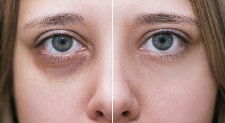 عکس قبل و بعد کربوکسی تیرگی زیر چشم