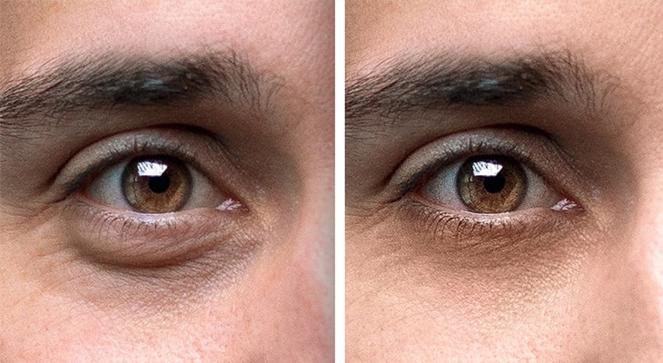 درمان سیاهی و گودی زیر چشم و افتادگی پلک با پلاسما