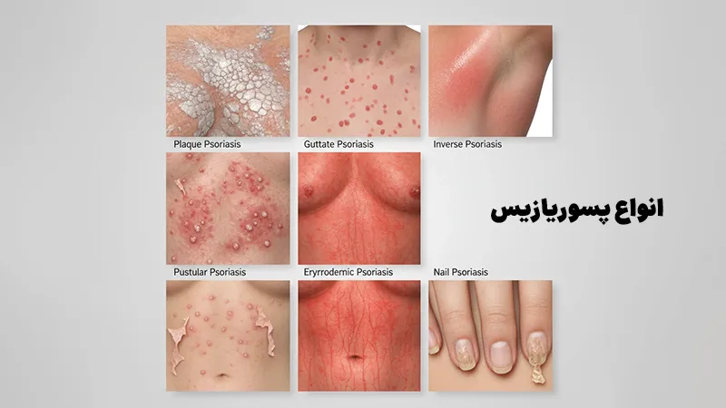 انواع پسوریازیس