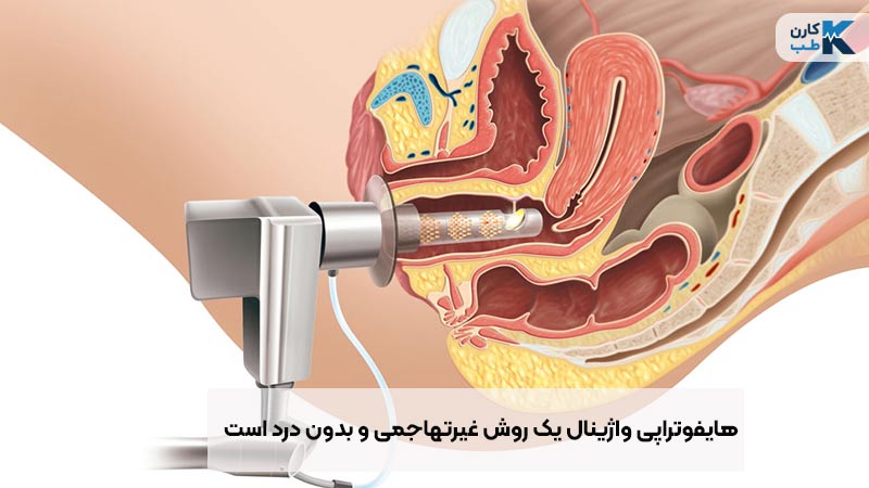 هایفوتراپی واژینال یک روش غیره تهاجمی است.