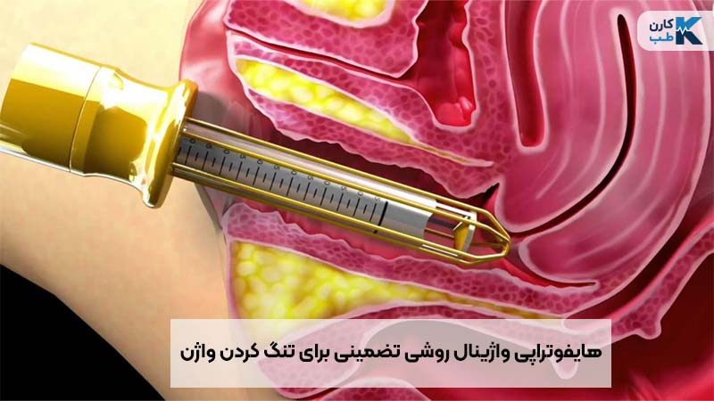 هایفوتراپی واژینال یک روش بدون درد است.