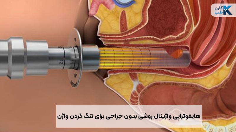 هایفوتراپی واژینال بهترین روش برای تنگ کردن واژن است.