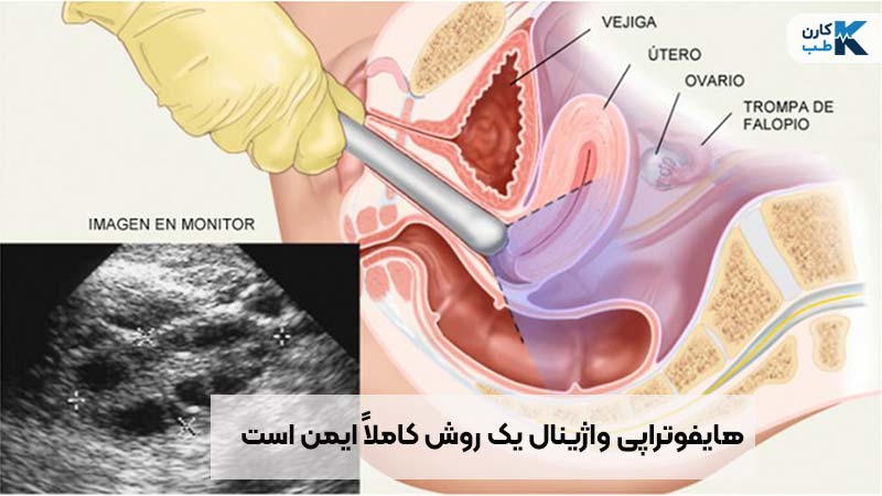 هایفوتراپی واژینال یک روش تضمینی است.
