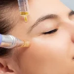 کربوکسی تراپی یا میکرونیدلینگ