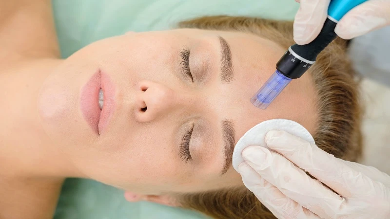 مقایسه تخصصی کربوکسی‌تراپی و میکرونیدلینگ