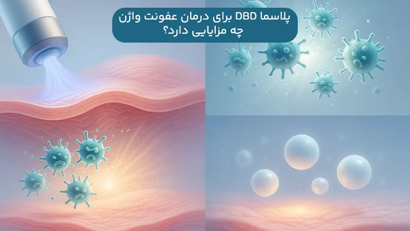 مزایای پلاسما DBD برای درمان عفونت واژن