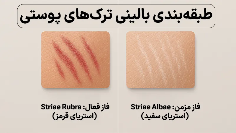 استرچ مارک چه انواعی دارد؟