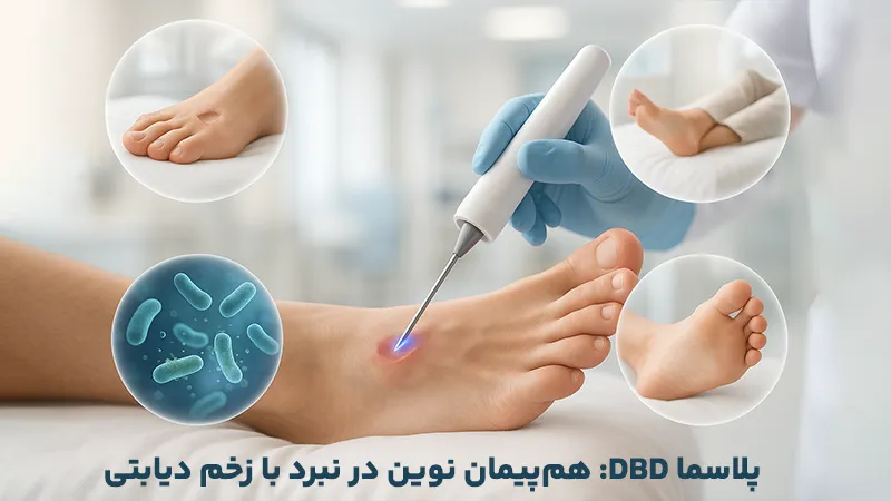 مزایای DBD پلاسما برای زخم‌های دیابتی