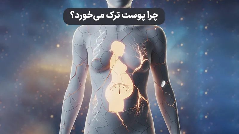 علل ایجاد استرچ مارک