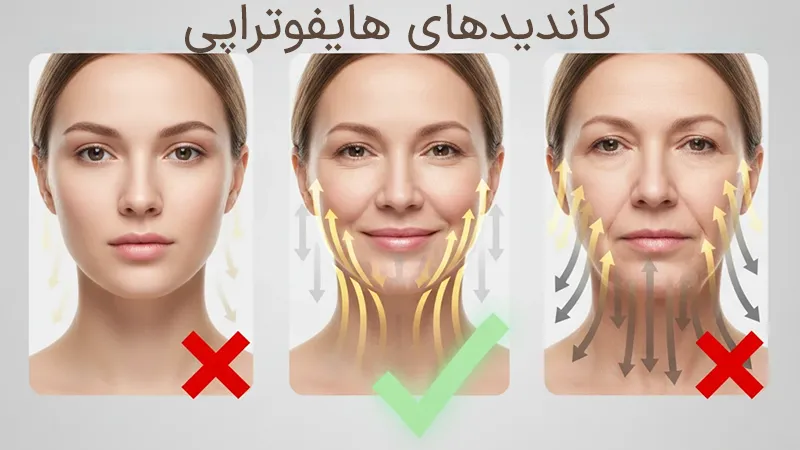 بهترین کاندیداهای هایفوتراپی