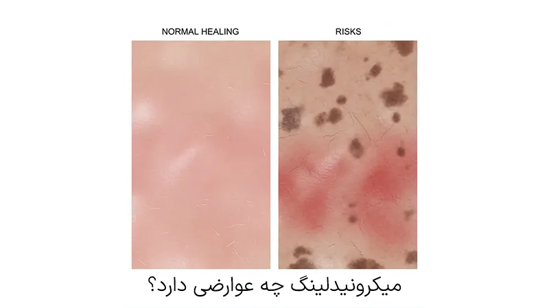 عوارض میکرونیدلینگ