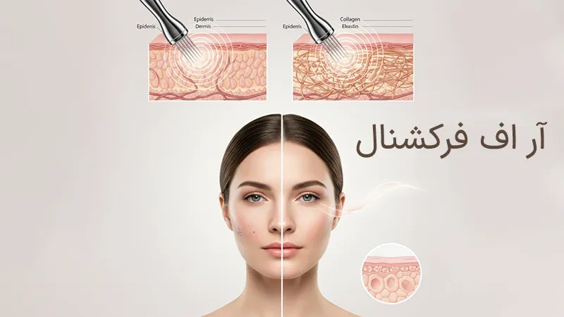 آر اف فرکشنال