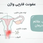 درمان عفونت قارچی واژن