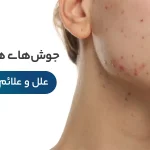 علل و علائم درمان جوش های هورمونی